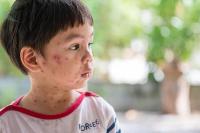 Di musim libur sekolah, orang tua perlu melindungi anak dari penularan penyakit cacar air dan gondongan (foto:ilustrasi anak terkena cacar air)